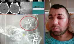 Bursa'da Diş İmplantı Operasyonunda Skandal: İmplant Vidası Hastanın Beynine Saplandı!