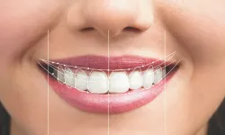 Diş Tedavisinde Yeni Dönem! Genel Anesteziyle Korkusuz ve Tek Seansta Estetik Çözümler