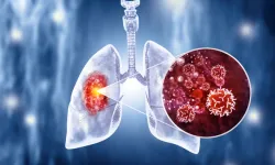 Akciğer Kanseri Riski Nasıl Azalır? Neler Yemeliyiz?