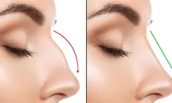 Nefes Aldıran Rinoplasti. Estetikten Fazlası