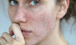 Kışın bakım rutini değiştirilmeli! Soğuk havanın cilde etkileri