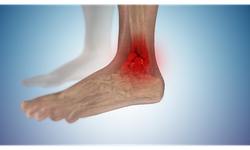 Ayak bileği burkulmalarını hafife almayın