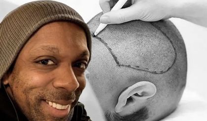 Saç Ekimi Sonrası Ölüm: İngiliz Vatandaş Hayatını Kaybetti