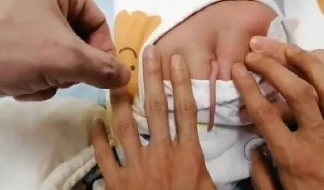 Bir Bebek, Doğumda 10 Santimetrelik Kuyrukla Dünyaya Geldi: Olağanüstü Tıbbi Durum Çin'de Gündemde