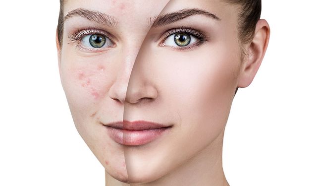 Cilt lekeleri neden artıyor? Uzmandan yaz sonrası kritik uyarı