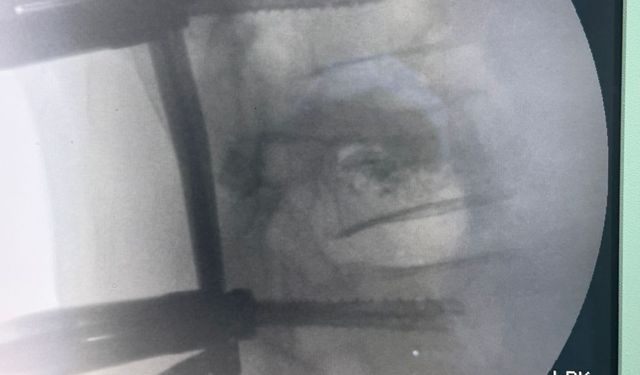 Trabzon'da omurga vidalama ameliyatı geçiren hasta sağlığına kavuştu