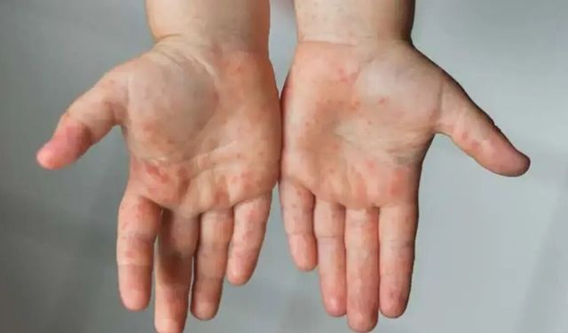 Havuzlardaki el ayak ve ağız hastalığı tehlikesine dikkat
